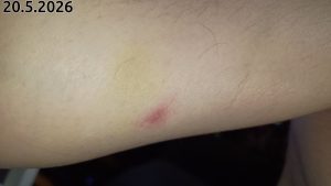Borrelioosi 2026-05-20 