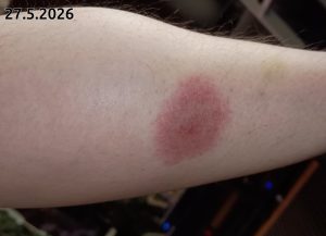 Borrelioosi 2026-05-27