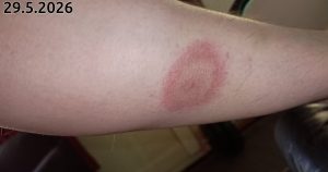 Borrelioosi 2026-05-29