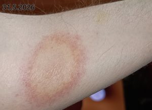 Borrelioosi 2026-05-31