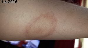 Borrelioosi 2026-06-01