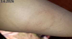 Borrelioosi 2026-06-03