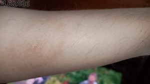 Borrelioosi 2026-06-04