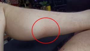 Borrelioosi 2026-06-07