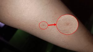 borrelioosi 2026-06-12
